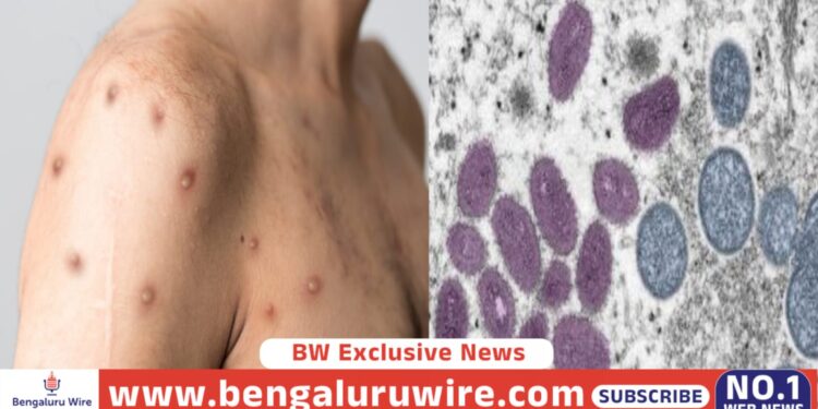 ಮಂಕಿಪಾಲ್ಕ್ ಕಾಯಿಲೆ ಬಂದಾಗ ಮೈಮೇಲೆ ದದ್ದು ಕಾಣಿಸಿಕೊಳ್ಳುವ ರೋಗಲಕ್ಷಣ ಒಂದು ಚಿತ್ರದಲ್ಲಿದೆ. ಮತ್ತೊಂದು ಚಿತ್ರದಲ್ಲಿ ಎಂಪಾಕ್ಸ್ ವೈರಾಣು ಚಿತ್ರ. (ಚಿತ್ರಕೃಪೆ : WHO)